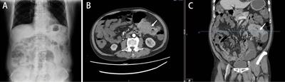 Colon cancer patient with long-term colon stent placement: Case report and literature review